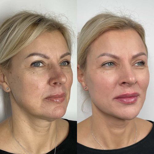 When Can I Smoke After Lip Filler