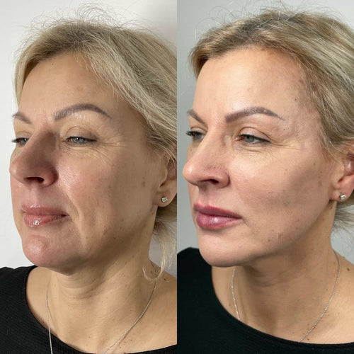 When Can I Smoke After Lip Filler